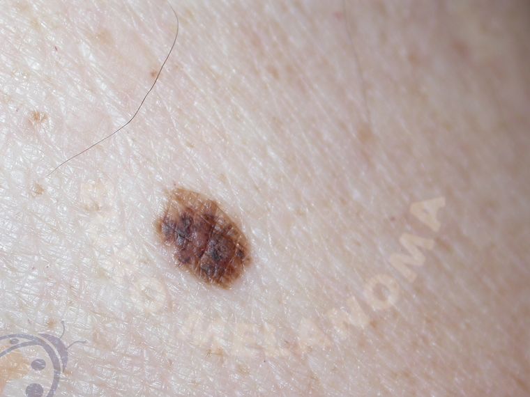 Types of skin cancer - Melanoma - Euromelanoma